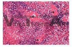 The slice of hyaline degeneration with spleen central artery